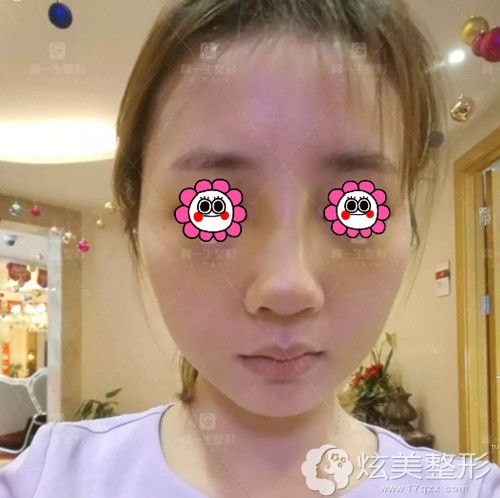 术后7天鼻子拆完线的样子