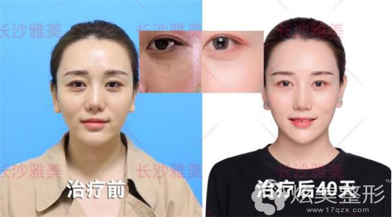 长沙雅美玉肌术真人体验前后对比 长沙雅美玉肌术真人体验前后对比