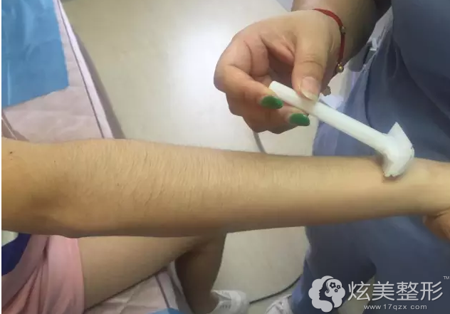 激光脱毛术前挂掉毛发 激光脱毛术前挂掉毛发