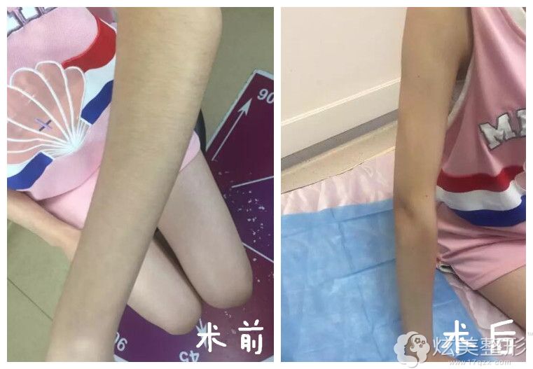长沙美莱激光脱毛术前术后对比 长沙美莱激光脱毛术前术后对比