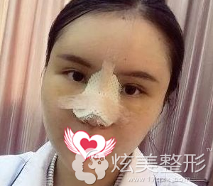 刚做完手术鼻子肿胀感较强 刚做完手术鼻子肿胀感较强