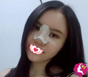 术后3天鼻子有些肿胀 术后3天鼻子有些肿胀