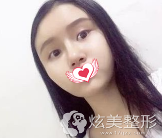 术后20天鼻子完全消肿 术后20天鼻子完全消肿