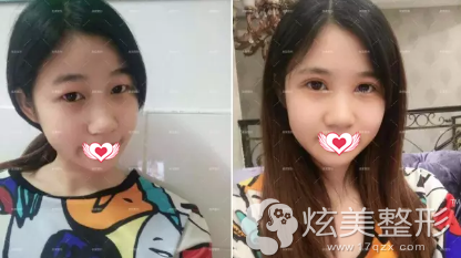 宜昌亚太双眼皮真人案例 宜昌亚太双眼皮真人案例