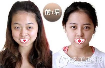 宜昌奥莱双眼皮真人案例 宜昌奥莱双眼皮真人案例