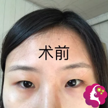 术前单眼皮小眼睛 术前单眼皮小眼睛