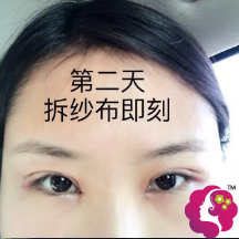 双眼皮手术后第2天恢复情况 双眼皮手术后第2天恢复情况