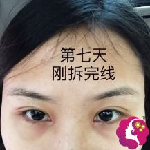 术后7天双眼皮拆线后的样子 术后7天双眼皮拆线后的样子