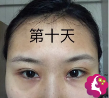 术后10天双眼皮已经消肿 术后10天双眼皮已经消肿
