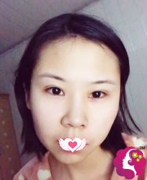 术后1个月双眼皮恢复自然 术后1个月双眼皮恢复自然