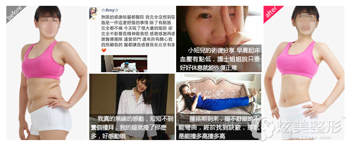 高海燕博士吸脂案例分享 高海燕博士吸脂案例分享