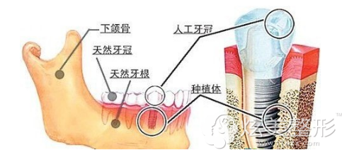 武汉冠美采用NYS多牙缺失种植修复体系 武汉冠美采用NYS多牙缺失种植修复体系