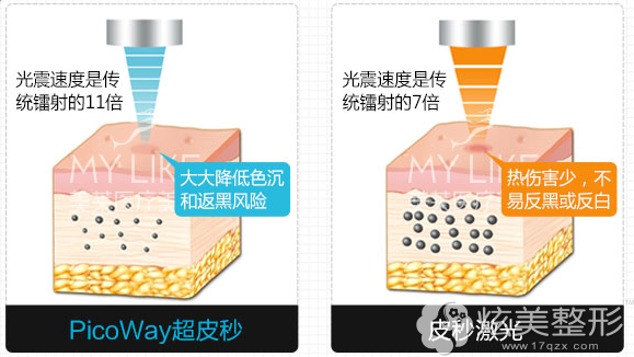 从安全对比超皮秒和皮秒 从安全对比超皮秒和皮秒
