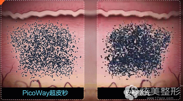 从效果对比超皮秒和皮秒 从效果对比超皮秒和皮秒