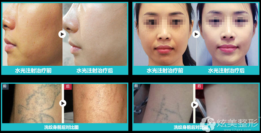 杨裙带美肤案例 杨裙带美肤案例