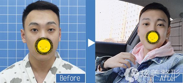 医疗美容上睑整形吉林（整形医院有没有上眼睑提拔
）《整形医院有没有上眼睑提升》
