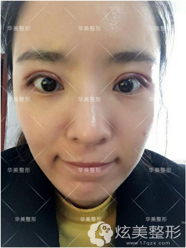 刚做完双眼皮手术眼睛肿胀 刚做完双眼皮手术眼睛肿胀