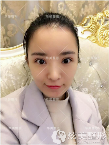 术后10天双眼皮消肿 术后10天双眼皮消肿