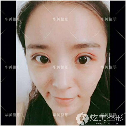 双眼皮术7天拆线后的样子 双眼皮术7天拆线后的样子
