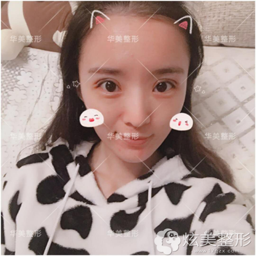 术后5天双眼皮微肿 术后5天双眼皮微肿