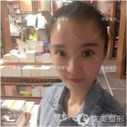 恢复第18天双眼皮款窄适中 恢复第18天双眼皮款窄适中
