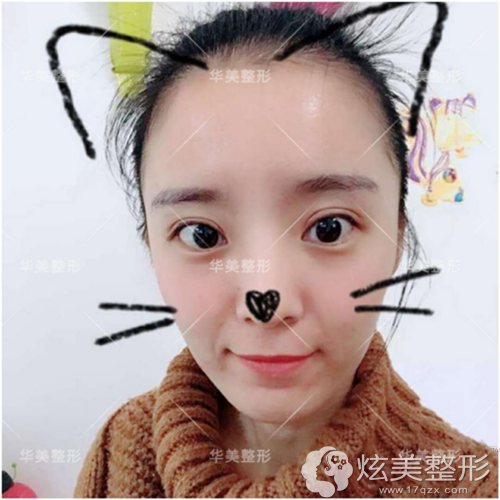 术后1个月双眼皮恢复自然流畅 术后1个月双眼皮恢复自然流畅