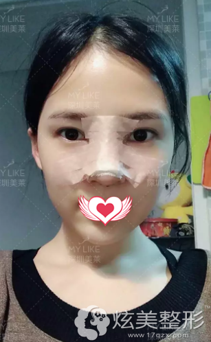 刚做完鼻综合修复鼻子肿胀 刚做完鼻综合修复鼻子肿胀