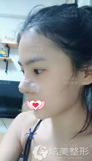 术后7天鼻子拆线鼻子稍微肿胀 术后7天鼻子拆线鼻子稍微肿胀