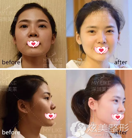 鼻综合失败修复前后对比 鼻综合失败修复前后对比