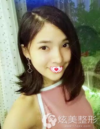 鼻综合术后3个月鼻子恢复自然 鼻综合术后3个月鼻子恢复自然