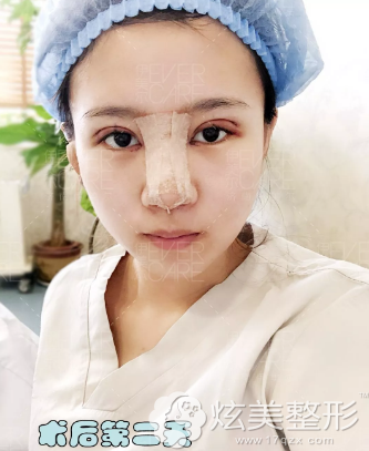 术后第二天眼鼻肿胀 术后第二天眼鼻肿胀