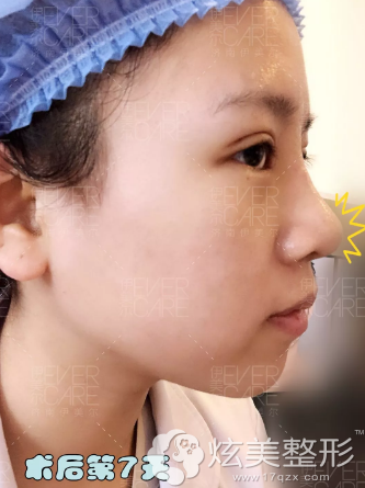 术后7天眼鼻拆线后的样子 术后7天眼鼻拆线后的样子