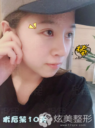 眼鼻综合第10天恢复情况 眼鼻综合第10天恢复情况