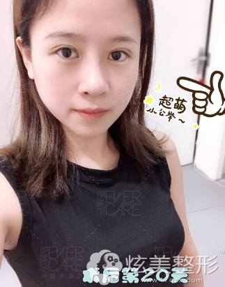 眼鼻综合20天后创口痕迹消失 眼鼻综合20天后创口痕迹消失