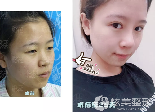 术后25天眼鼻恢复自然 术后25天眼鼻恢复自然