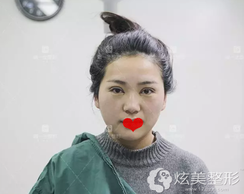刚做完眼综合手术眼睛肿胀 刚做完眼综合手术眼睛肿胀