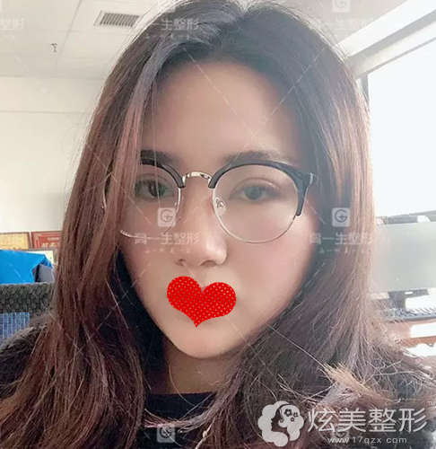 双眼皮术后5天拆线后的样子 双眼皮术后5天拆线后的样子