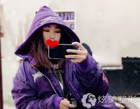 术后3天双眼皮肿胀感较轻 术后3天双眼皮肿胀感较轻