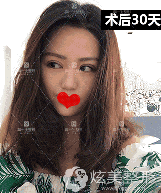 眼综合恢复1个月特别自然 眼综合恢复1个月特别自然