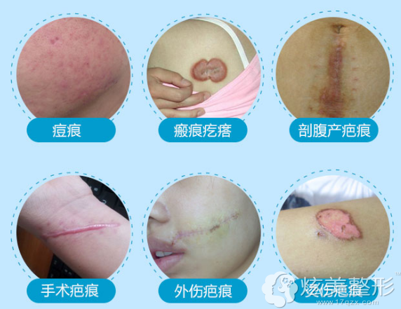 常见的疤痕分类 常见的疤痕分类