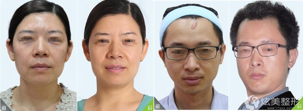 舒宽明医生祛疤案例 舒宽明医生祛疤案例