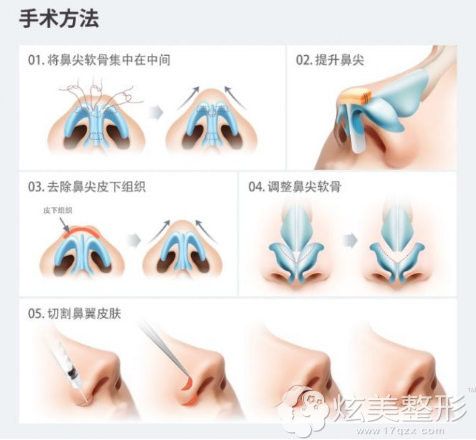 蒜头鼻的手术方法 蒜头鼻的手术方法
