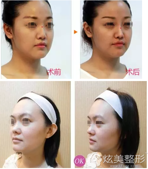 罗东阳鼻综合案例 罗东阳鼻综合案例