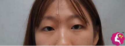 术前单眼皮小眼睛