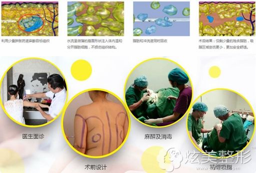 水动力吸脂技术 水动力吸脂技术