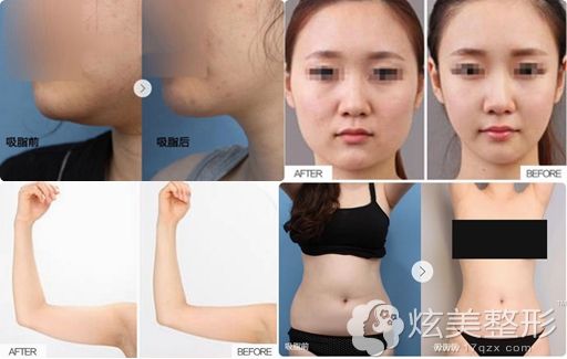 在蚌埠美莱坞水动力吸脂案例 在蚌埠美莱坞水动力吸脂案例