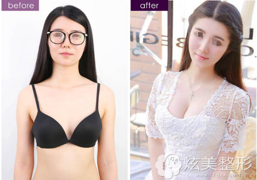 柳成医生假体隆胸术前术后对比 柳成医生假体隆胸术前术后对比