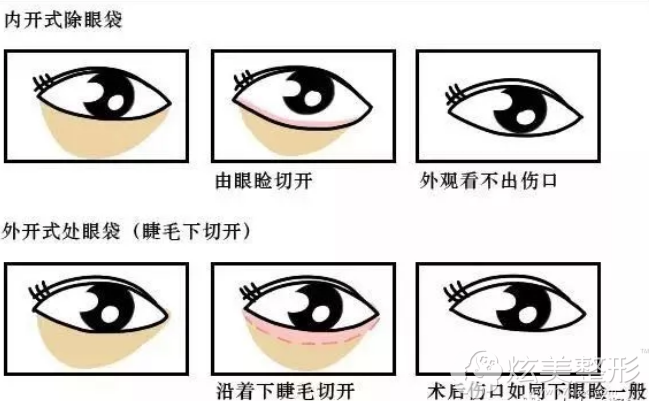 内切法和外切法去眼袋原理 内切法和外切法去眼袋原理