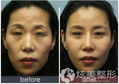 孙振东院长自体脂肪填充案例 孙振东院长自体脂肪填充案例