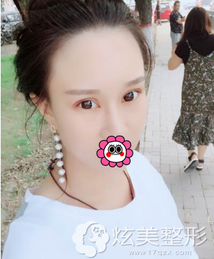 热敷一个月后双眼皮渐渐恢复自然 热敷一个月后双眼皮渐渐恢复自然